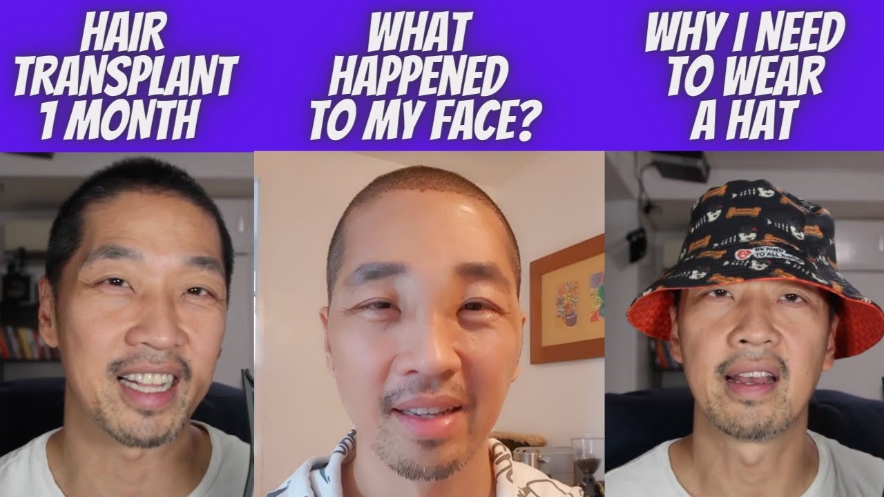 My Hair Transplant After A Month: WHAT HAPPENED?