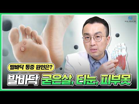 발바닥 통증 원인은? 발바닥 굳은살, 티눈, 피부못 #부산발정형외과 #부산발목발통증 #부산발전문정형외과 #무지외반증 #티눈굳은살