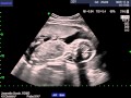 baby deen heartbeat 20 weeks