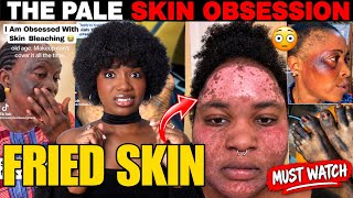 SKIN BLEACHING GONE WRONG! The Skin Whitening Epidemic Is Out Of Control| SKIN LIGHTENING & COLORISM