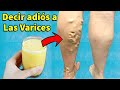 Con 1 Taza Por La Mañana - Decir Adiós A Tus Varices