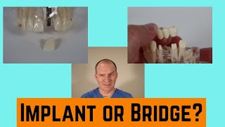 What is better dental implant or bridge?