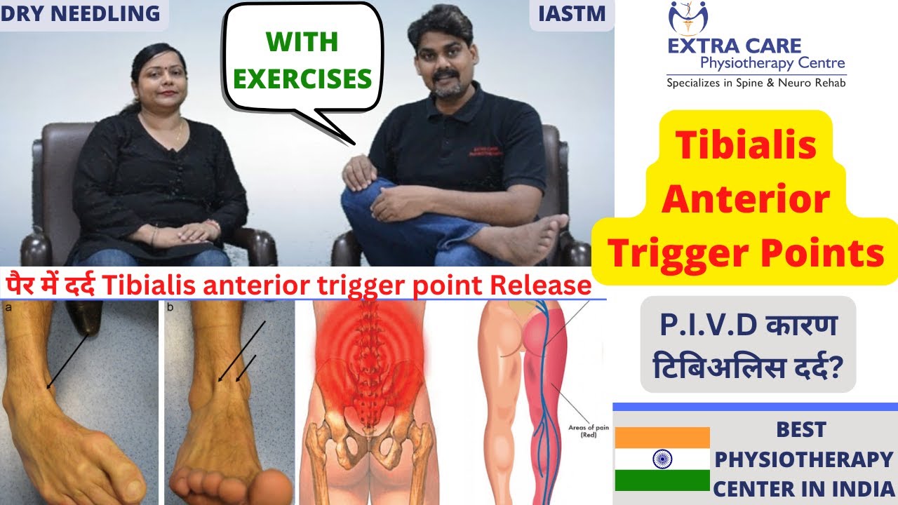 Releasing Trigger Points for Tibialis Anterior via Dry Needling