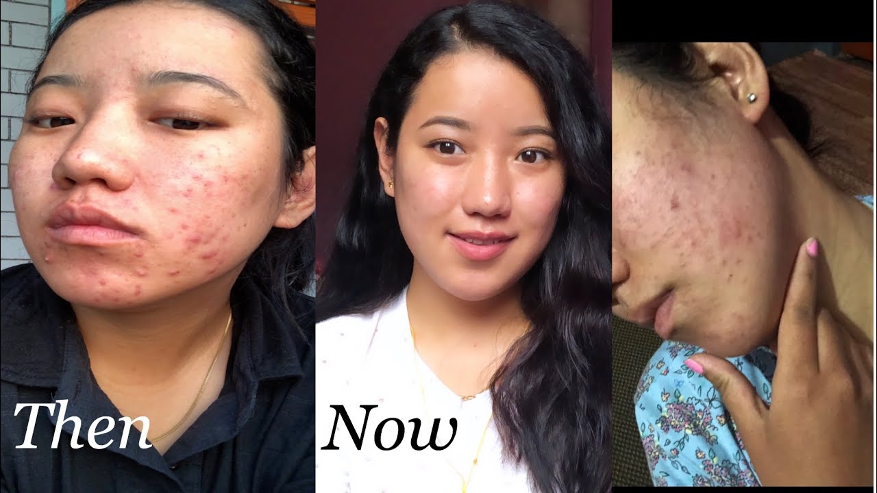 How I Get Rid OF Acne & Pimples || Sharing My Journey || - YouTube