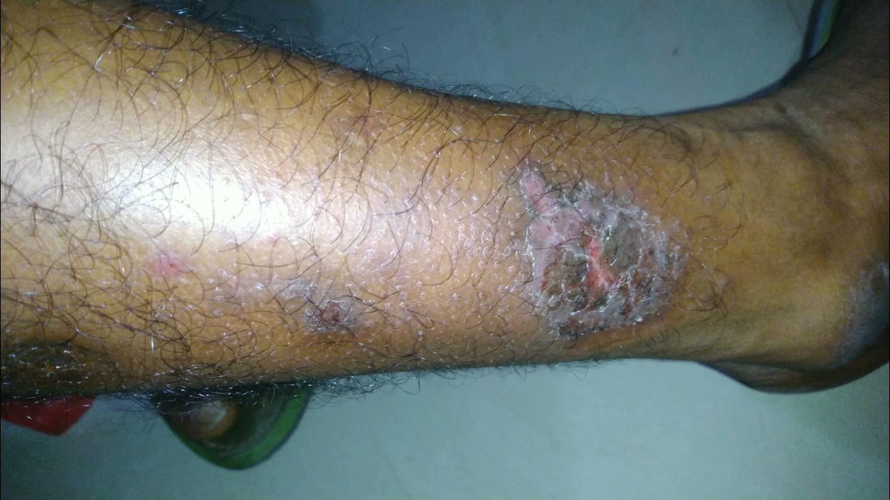 Eczema with Secondary Impetigo Contagiosum eczema Impetigo 