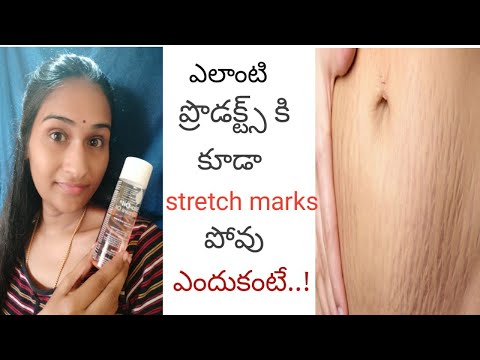 how to avoid stretch marks||uses of bio oil||treatment for stretch marks | in telugu