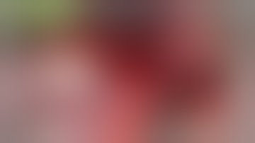 Computer Guided (MGuide) Implant Placement # 2 & Gingival Augmentation, Mucoderm ( Botiss)