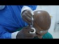Bald Man gets a 3500 Grafts Hair Transplant in India