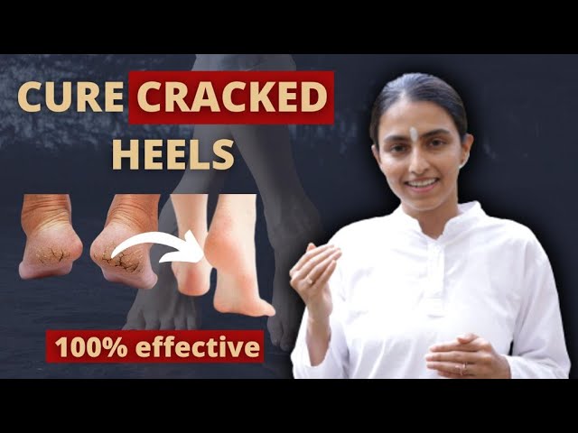 STEP INTO COMFORT: AYURVEDIC REMEDIES FOR CRACKED HEELS | - DiscountMags.com