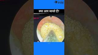 Kidney stone treatment | pcnl | live OT