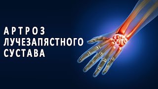 Что нужно знать об артрозе лучезапястного сустава видео Лечение артрита суставов кисти руки и лучезапястного сустава
