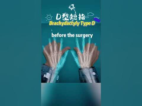 Brachydactyly Type D#Brachydactyly - YouTube