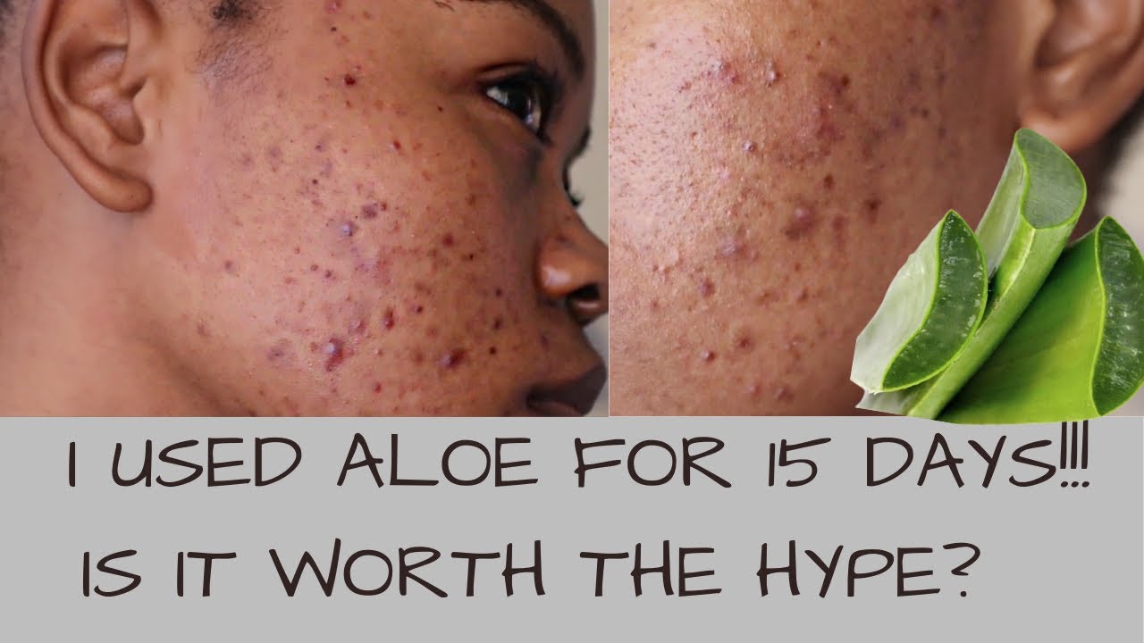 I USED ALOE VERA ON MY ACNE/ SCARS (SPOTS) FOR 15 DAYS & THIS HAPPENED  (before & after demonstrated) - YouTube