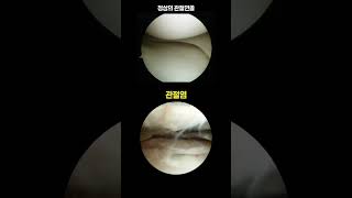 오금통증 반월상연골 견열파열을 방치하면 생기는 문제점