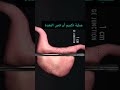 هكذا تتم عملية تكميم المعدة أو قص المعدة 