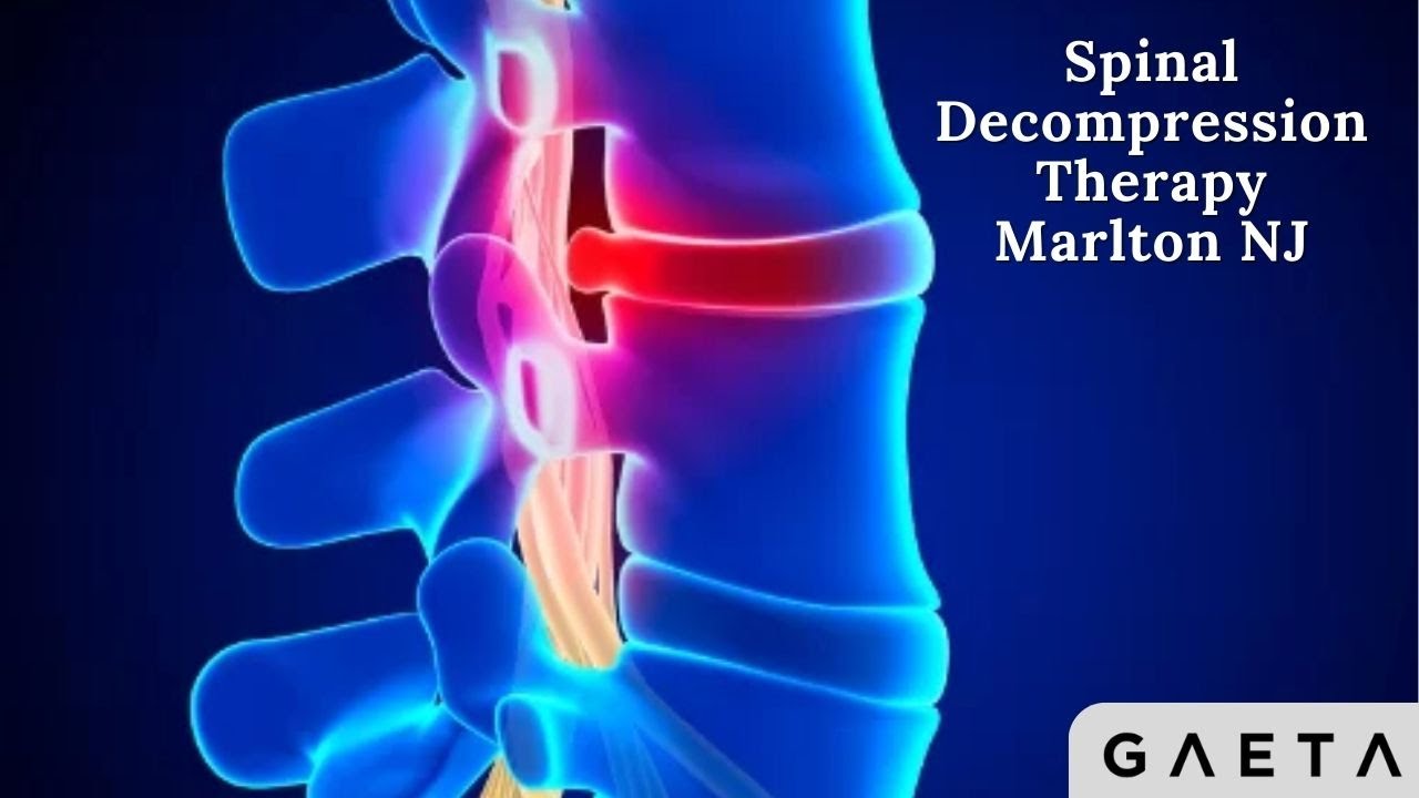 Does spinal decompression work marlton nj youtube