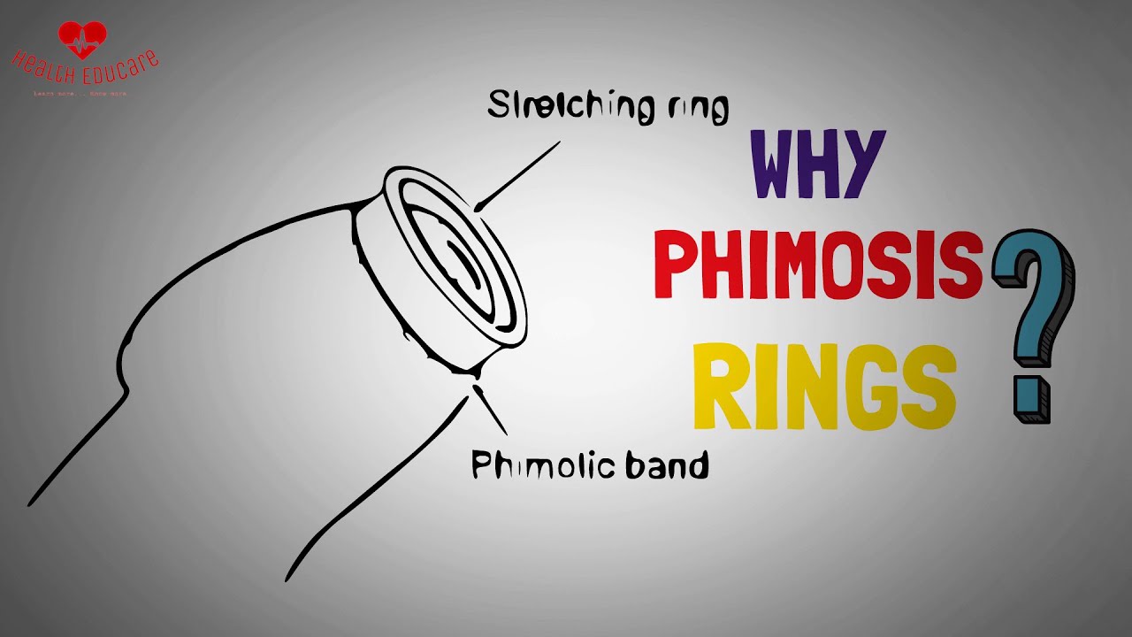 Phimosis Stretching Rings Kit for tight foreskin treatment