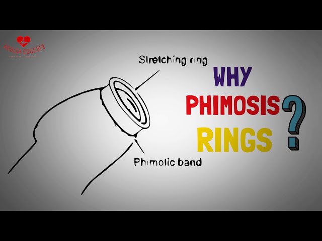 Are Phimosis Rings Effective for Stretching your for Foreskin