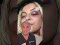 @BEBEREXHA gets struck in the face with an iPhone while performing. #fue #hair #hairtransplant