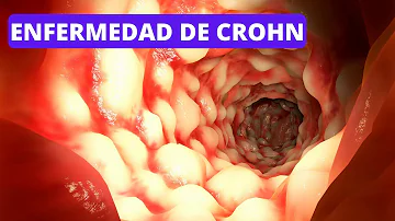 ¿Cuáles son los síntomas de un brote grave de Crohn?