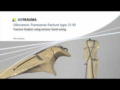 Olecranon - Fracture Fixation Using Tension Band Wiring