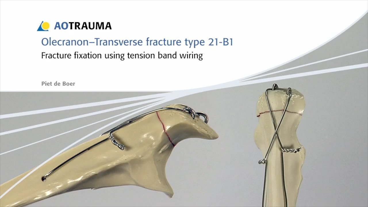 Fixation of ring fixator to proximal tibia. (a) Transverse wire