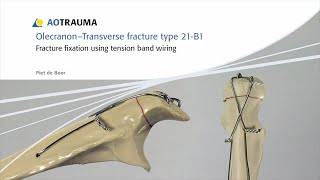 Olecranon - Fracture Fixation Using Tension Band Wiring