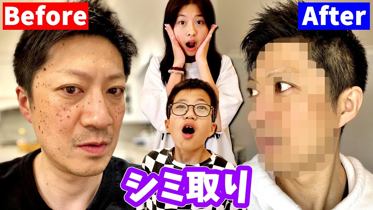 シミ取り かほせいの反応は❓ついにパパ シミ取りしました? - YouTube