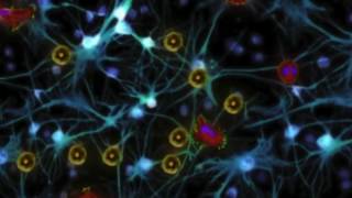 Animation of stem cell therapy attacking deadly brain cancer