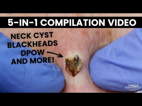 Best short pops of the week: Blackheads and Cysts | CONTOUR DERMATOLOGY