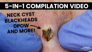 Best short pops of the week: Blackheads and Cysts | CONTOUR DERMATOLOGY