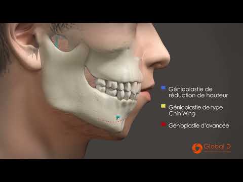 Genioplastie, ostéotomie du menton