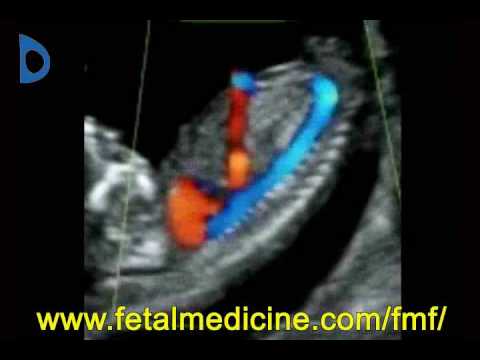 Fetal Medicine Foundation - Ductus venosus