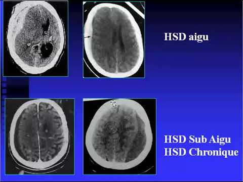 Vidéo: Malformation Artérioveineuse - Symptômes, Traitement, Formes, Stades, Diagnostic