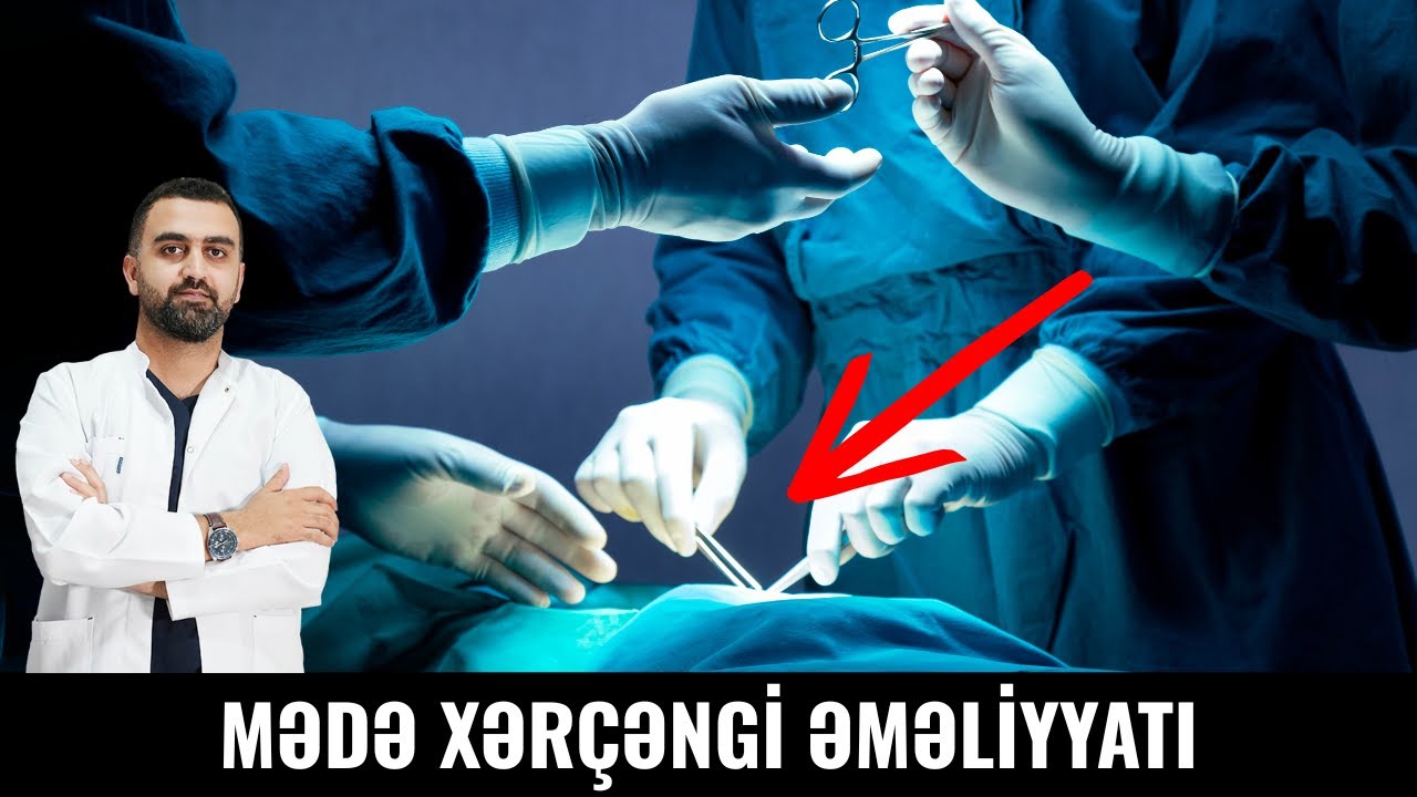 Mədə Xərçəngi Əməliyyatı necə edilir?