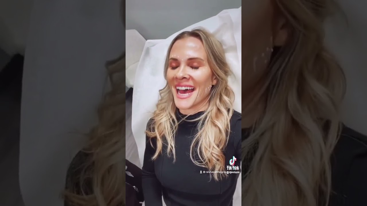 Botox Injections masseters and angular depressors