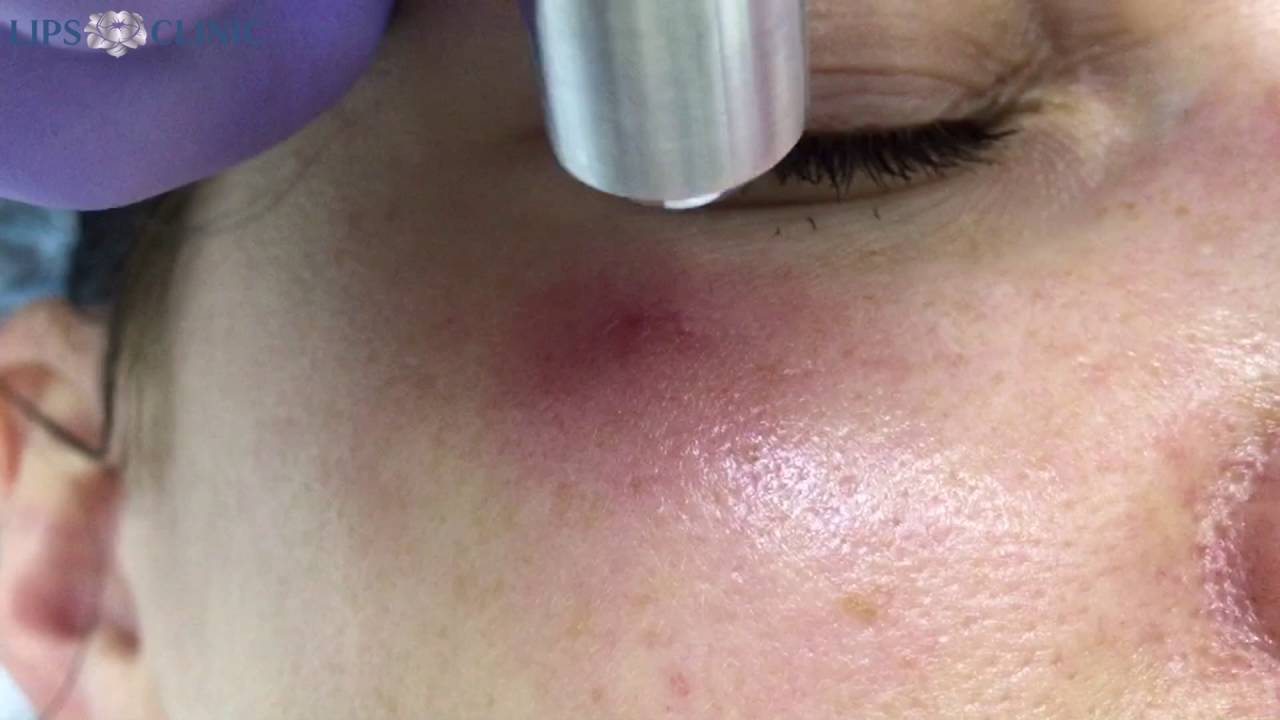 Удаление сосудистых звездочек лазером