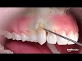Gum recession treatment  advanced dental implant and tmj center