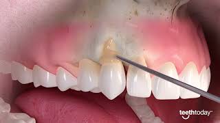 Gum Recession Treatment | Advanced Dental Implant and TMJ Center screenshot 2
