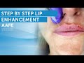 Lip filler tutorial  post care procedure
