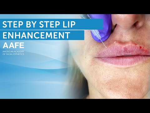 Lip Filler Tutorial + Post Care Procedure