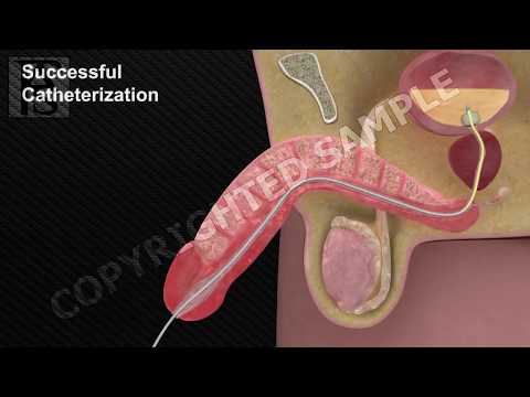 Video: Urethral Foder På Plats