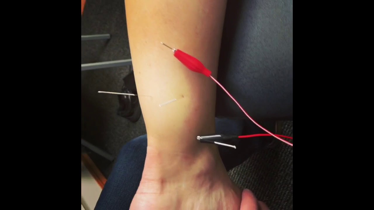 Dry Needling Electrical Stimulation (EStim) Treatment with Motion to