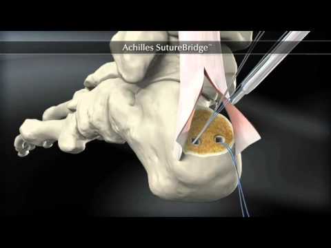 Achilles Suture Bridge 360 552WM