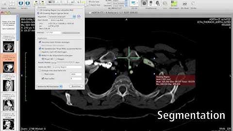 Segmentation and 3D Volumerendering