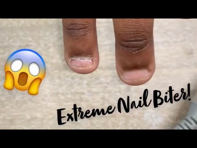 Extremely Bitten Nails Transformation | How to Repair Damaged Nails? -  YouTube