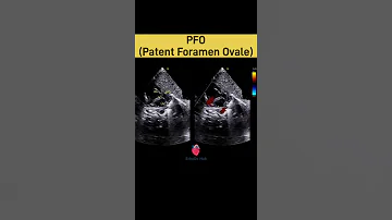 Patent Foramen Ovale PFO On 2D Echo EchoDx Hub EchoDxHub PFO PatentForamenOvale 2DEcho 
