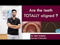 How do you know if teeth are COMPLETELY aligned?  |  Dr. Jiten Vadukul  |  The Orthodontist