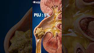 How a 10 mm Kidney Stone is Removed WITHOUT a Single Cut! 🤯 | 10 mm Kidney Stone Treatment