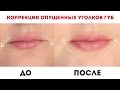 Коррекция опущенных уголков губ / Как приподнять уголки рта? / Диана Суворова